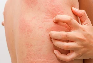 Phải Làm Sao Khi Đeo Bạc Bị Dị Ứng? 1 Số Cách Khắc Phục 